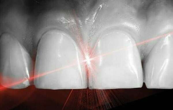 Le laser dans le traitement de la parodontite