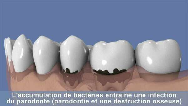 Le traitement non chirurgical de la parodontite
