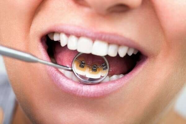 LA PÉRIODE DE CONTENTION ORTHODONTIQUE