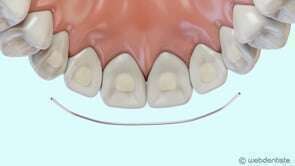 Fil de contention