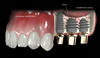 Comblement osseux et pose d'implants dentaires, implantologie à Bois-Guillaume près de Rouen