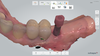 Empreinte 3D d'un implant dentaire affichée à l'écran, implantologie à Bois-Guillaume près de Rouen