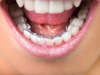 Orthodontie linguale - Dr TOUNGBO