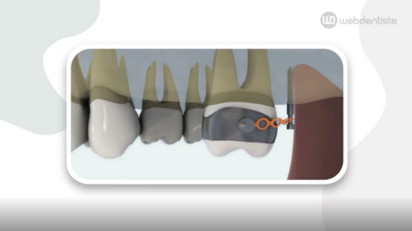 Implant orthodontique : redressement d'une molaire
