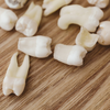 Plusieurs dents manquantes, implants dentaires, Cabinet dentaire Paris 8