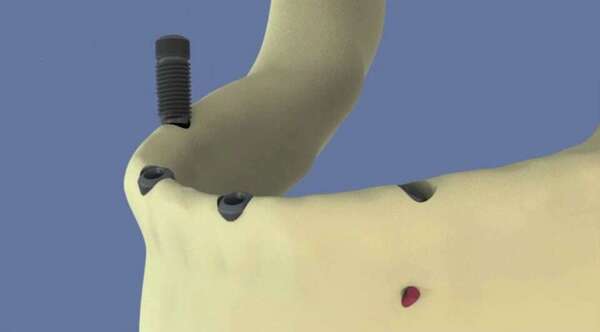 Mandibule : all-on-4