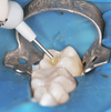 composite caries, Cabinet dentaire Paris 8 