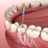 endodontie, Cabinet dentaire Paris 8