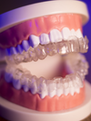 L'orthodontie invisible, Cabinet Dentaire Paris 8