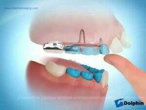 Correction habitude pouce dans la bouche