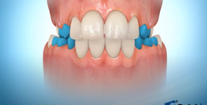 Quad-Helix Appliance