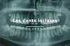 dents incluses