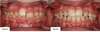 Les dents vue de face avant et après Traitement par éducateur fonctionnel