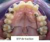 BTP de traction