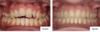 Traitement avec gouttières Invisalign avant et après