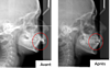Radiographie avant et après traitement appareil multi-attaches