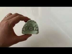 Que faire si un appareil fixe au palais se détache