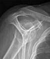 La tendinite des tendons de la coiffe des rotateurs