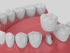 couronne dentaire protégeant un sourire harmonieux durable