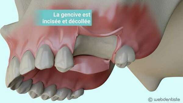 Comblement osseux après une extraction dentaire