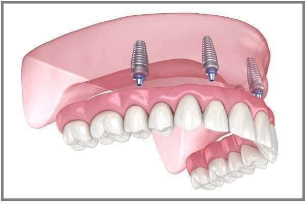 STABILISATION DES PROTHÈSES AMOVIBLES COMPLÈTES