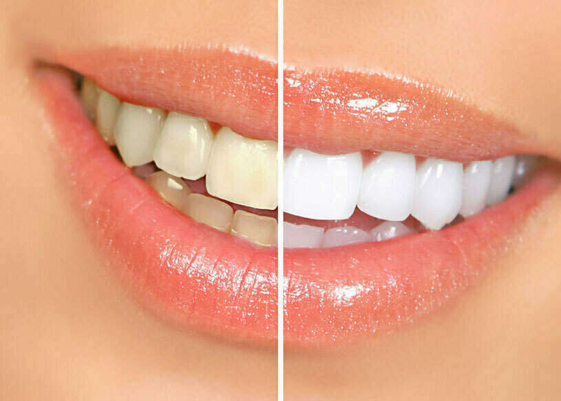 LE BLANCHIMENT DES DENTS AMBULATOIRE