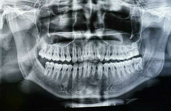 L'EXAMEN RADIOLOGIQUE PANORAMIQUE