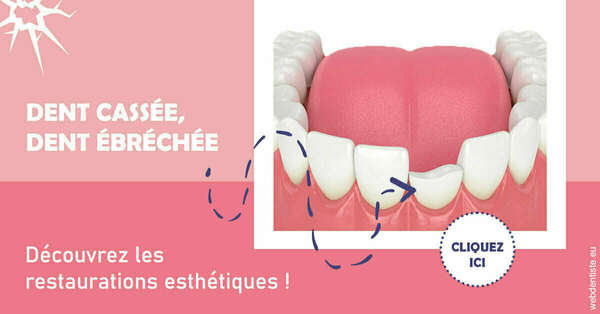 Dent cassée ébréchée