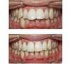 avantages bagues orthodontie