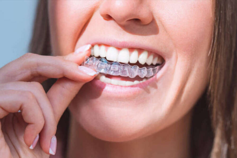 Les avantages et les limites du traitement Invisalign®