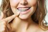 Appareil orthodontique classique