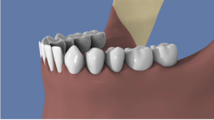Bloc osseux d'origine ramique