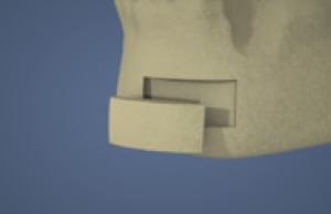 Bloc osseux d'origine symphysaire