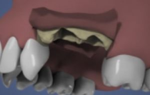 Extraction et comblement osseux