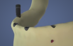 Mandibule : All on four