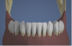 Mandibule : Bridge complet scellé sans fausse gencive