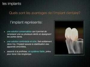 Qu'est-ce qu'un implant dentaire ?