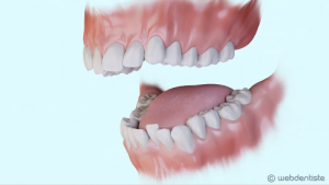 Traitement multi-attaches lingual