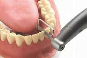 Le stripping dentaire, qu'est-ce que c'est ?