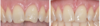 Composite esthétique sur incisive recréant symétrie dentaire