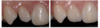 Dents extraites et bridges implantaires pour restauration esthétique