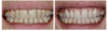 couronne tout céramique sur implant dentaire adulte