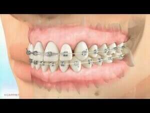 Carriere® Motion™ Appliance for Class II Patient Education Animation