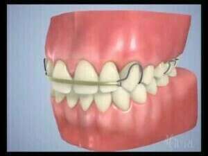 Appareil dentaire Amovible