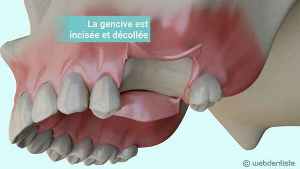 Comblement osseux après une extraction dentaire