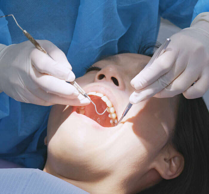 LE BRIDGE CANTILEVER ET LE BRIDGE COLLÉ