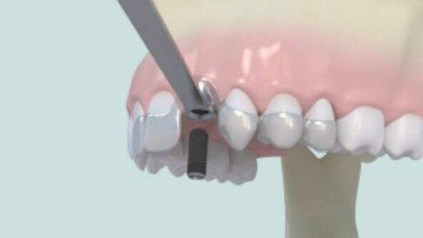 Dentisterie mini-invasive