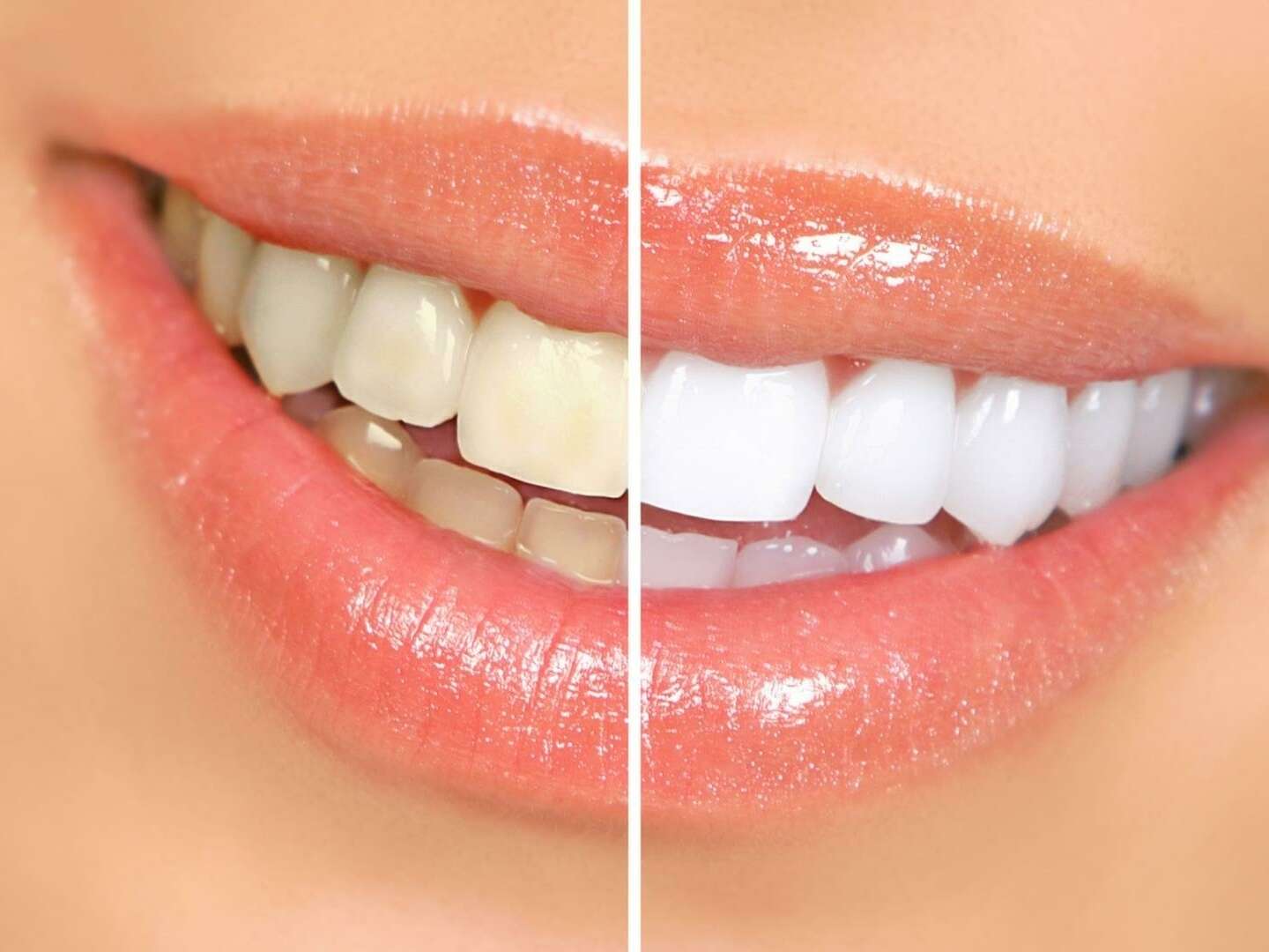 Teinte des dents avant et après éclaircissement