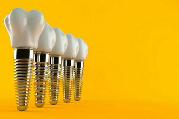 Application des implants – Paris 14