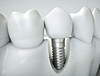 	Implant dentaire et sa couronne entre deux dents, vue 3D